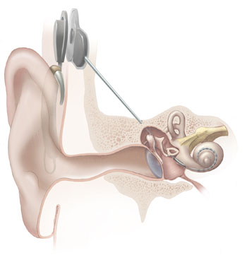 2014-04-30 Cochlear Implant