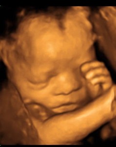 772 - Ultrasound at 26 Weeks